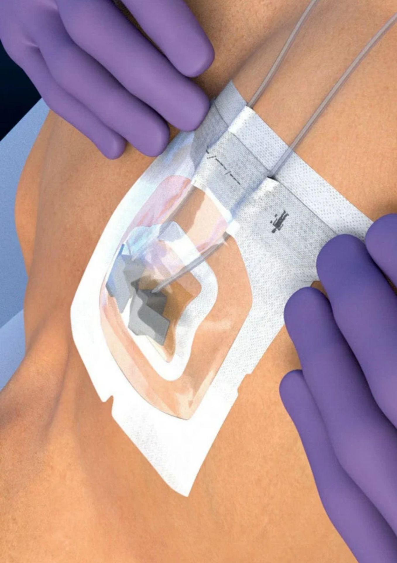 3M™ TEGADERM™ – VIŠE OD OBIČNOG FLASTERA
