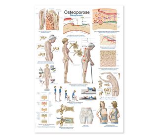 OSTEOPOROZA, ANATOMSKI POSTER, 50 × 70 cm, plastificirani