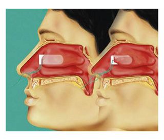 TAMPONADA K12 SINUS RAUCOCEL, 12 mm, 20 kom.