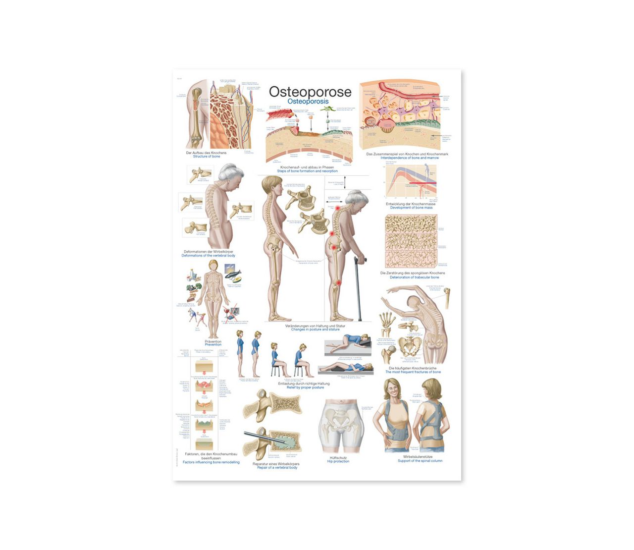 OSTEOPOROZA, ANATOMSKI POSTER, 50 × 70 cm, plastificirani