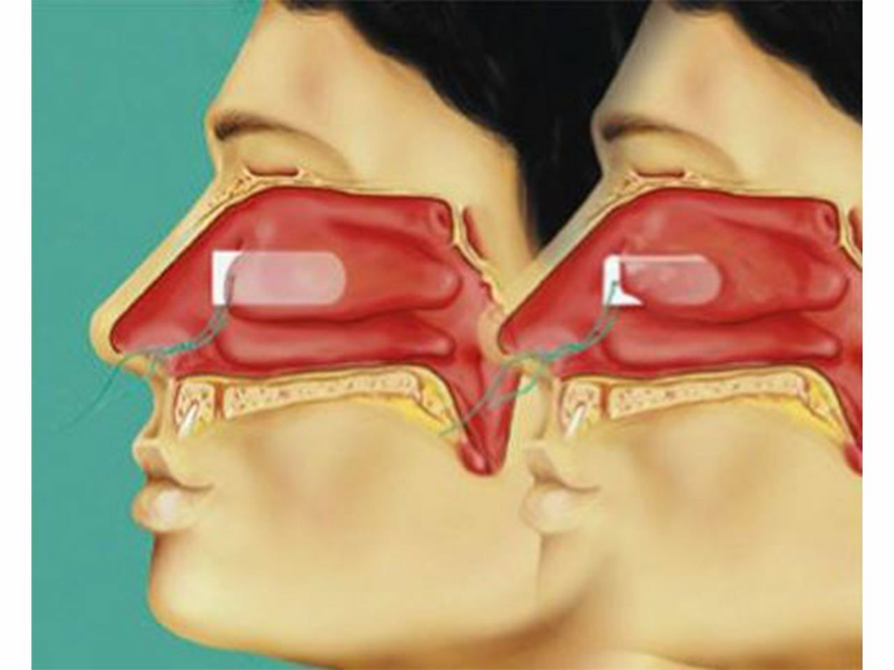 TAMPONADA K12 SINUS RAUCOCEL, 12 mm, 20 kom.